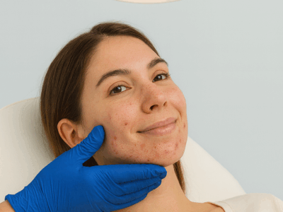 Acne dell’adulto: nuove soluzioni per una pelle sana e senza cicatrici